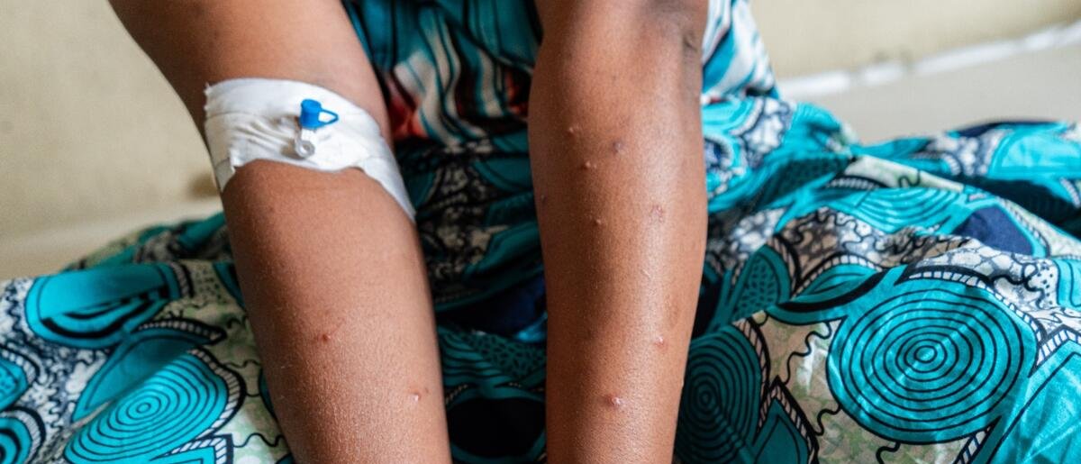 brazos de una mujer afectada por mpox