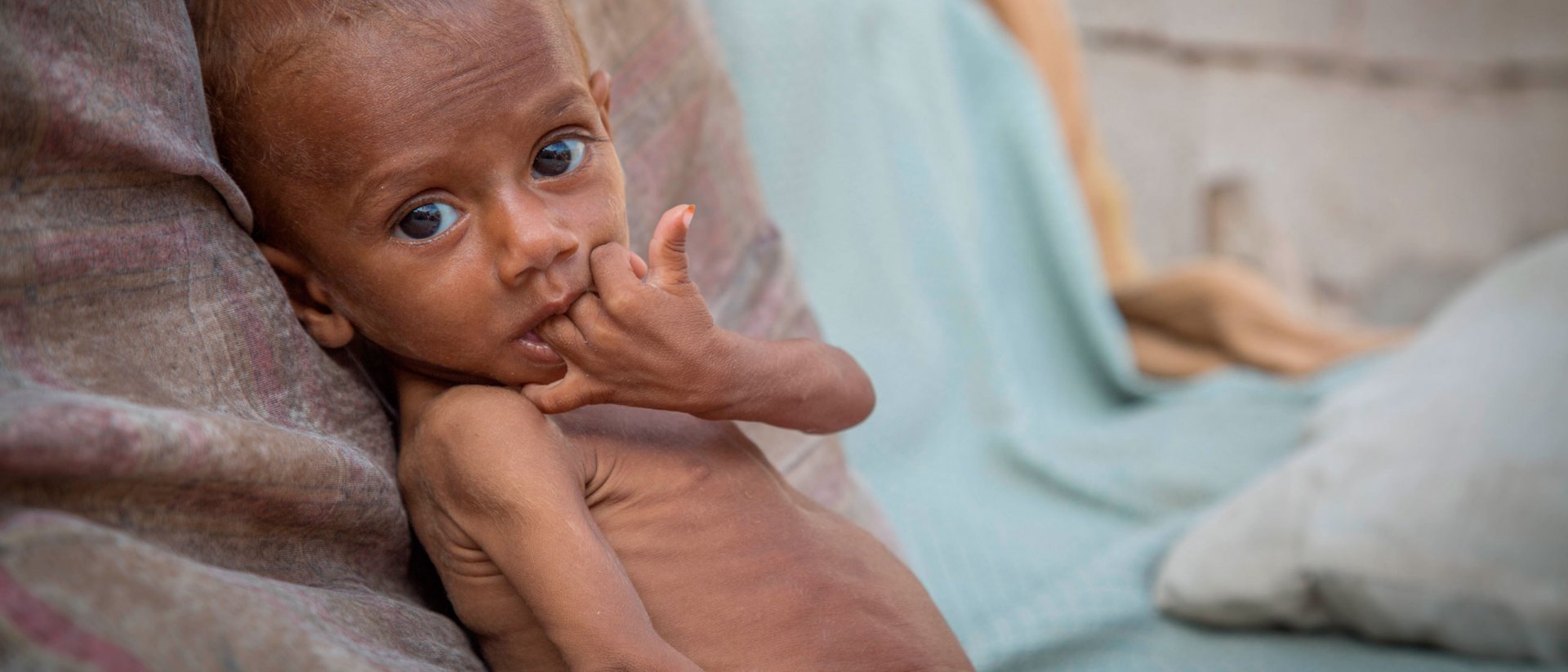 Nusair tenía 13 meses cuando le diagnosticamos con desnutrición severa